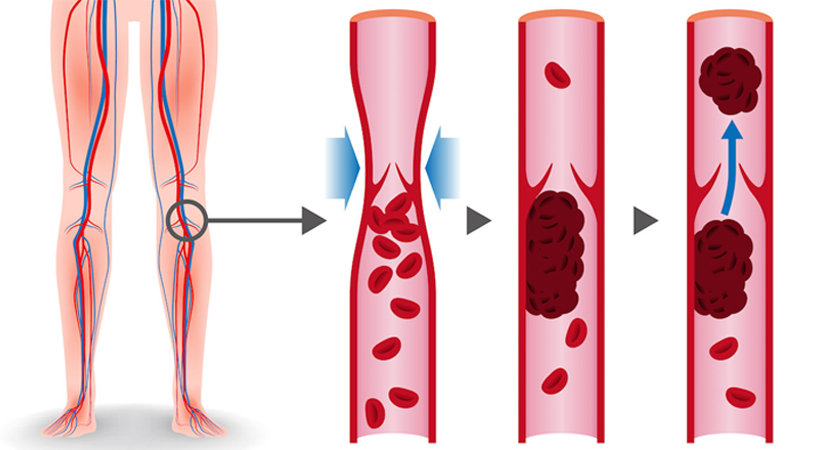 DVT is a blood clot formation in a deep vein in the leg