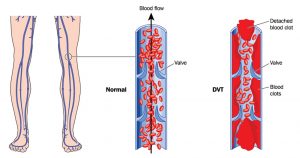 normal blood flow verses DVT blood clots - Vein Disease