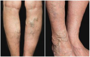 Being Over Weight Can Cause Painful Varicose Veins