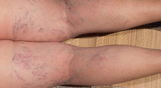 Spider Veins – How can I prevent them?