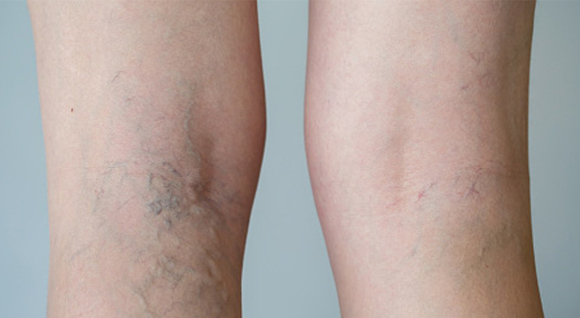 What is the difference between Spider Veins and Varicose Veins?