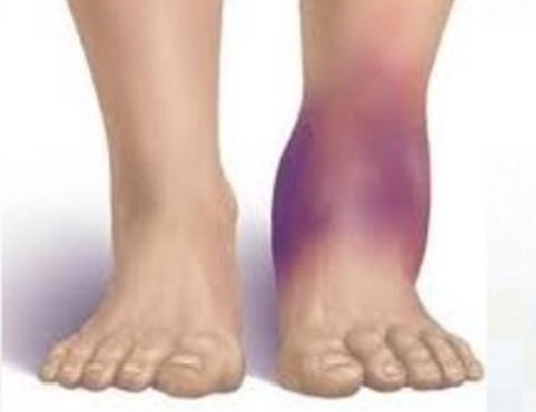 Being Dehydrated can cause swelling of feet and ankles, a health risk. 